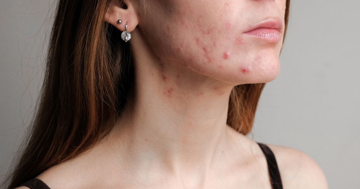 Cúrcuma para tratar acne